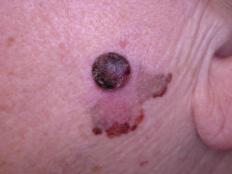 melanoma 1
